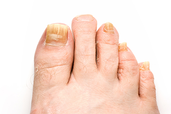 Fungal Nail Infection | Fungus Infection | Podiatrist Advice