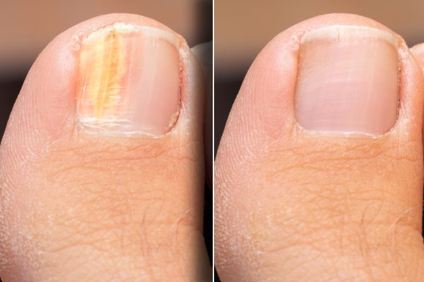 Laser Toenail Fungus Removal Treatment