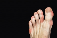 How Long Can Gout Last?