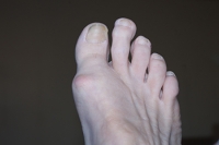 Facts About Morton’s Toe