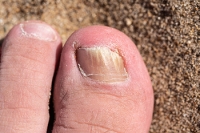 Is Laser Treatment Right for My Toenail Fungus?