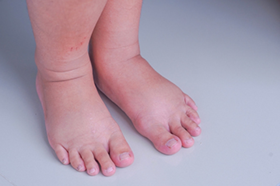 अंगुलियों या पैरों के पंजों में सूजन हो सकता है इस जानलेवा बीमारी का संकेत, भूलकर भी नहीं करें...-Swelling in the fingers or toes can be a sign of this deadly disease, do not do it even by mistake.